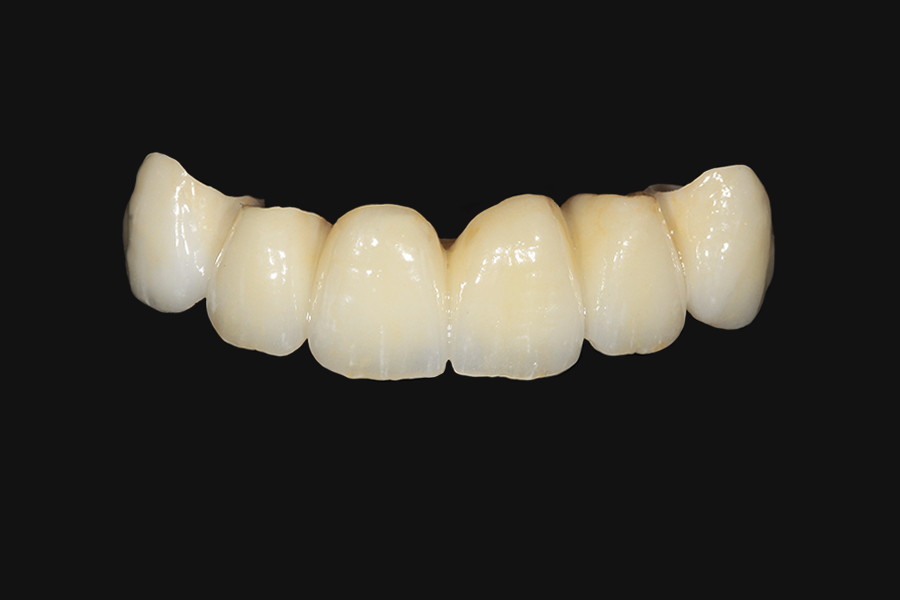 Puente en zirconia