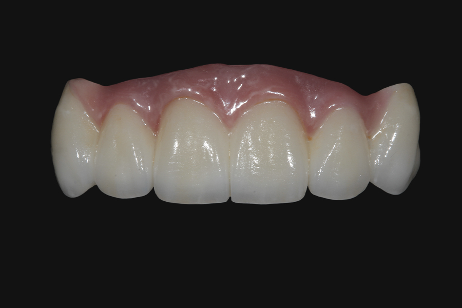Puente en zirconia