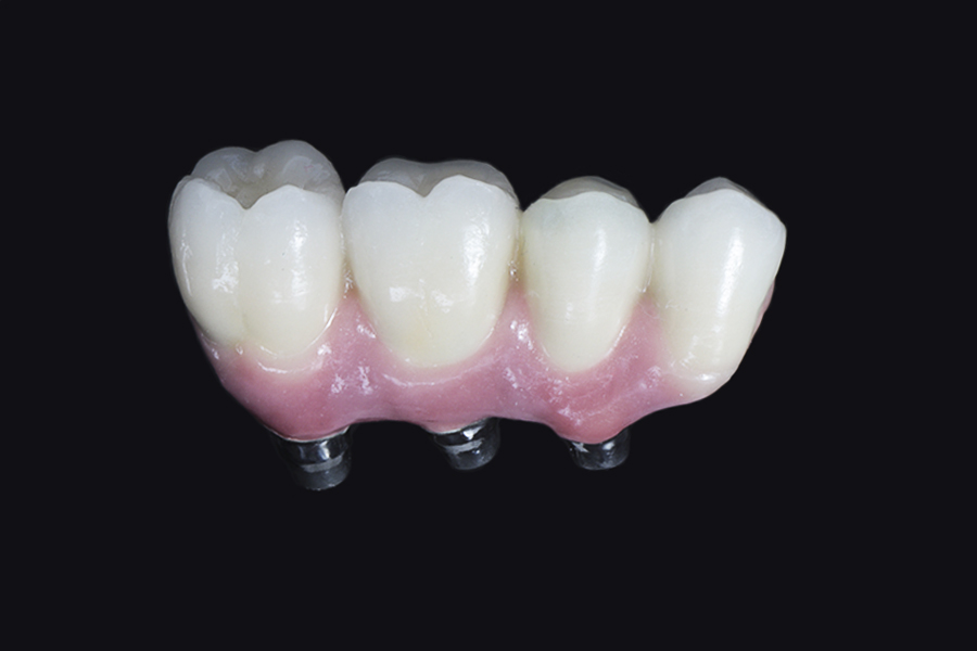 Puente sobre implantes