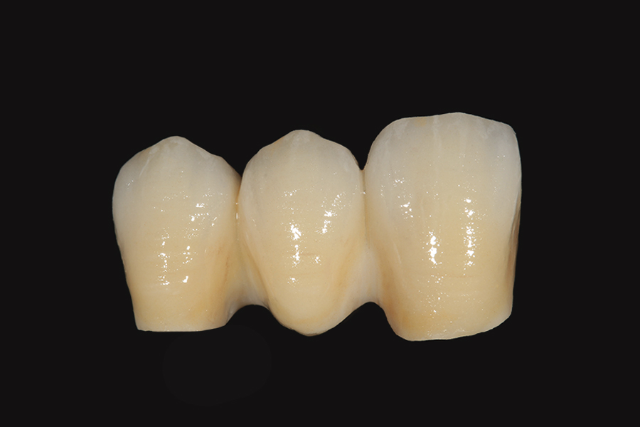 puente en zirconia