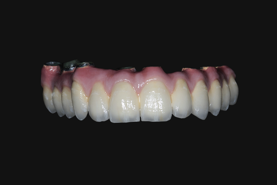 barra metal porcelana